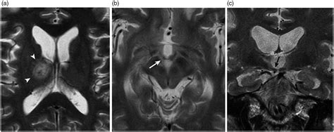 Mammillary Bodies Mri