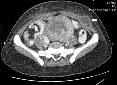 A 5 Mm Trocar Site Small Bowel Herniation After Laparoscopic Myomectomy