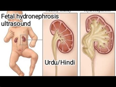 Anomaly Scan Fetal Hydronephrosis Ultrasound Urdu Hindi Youtube