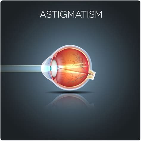 Astigmatism Example