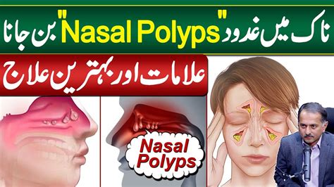 Gadood In Nose Or Nasal Polyps Symptoms And Treatment Of Nasal Polyps