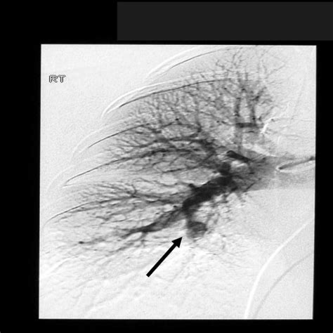 Pulmonary Angiography Showed A Single Aneurysm Of The Right Interlobar Download Scientific