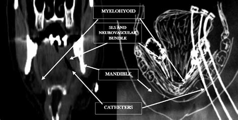 Diagram Showing How The Lingual Nerve Can Be Injured When Catheters Are