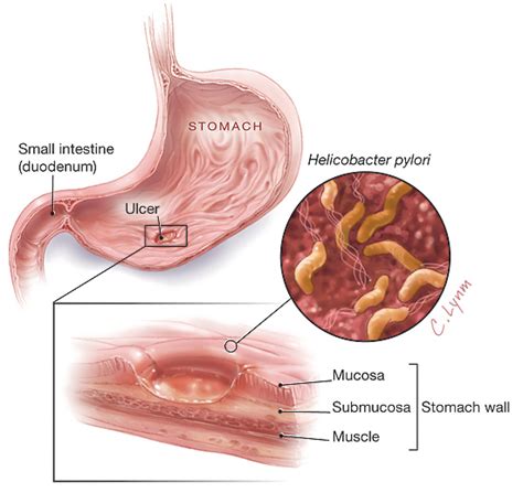 Helicobacter Pylori Gastroenterology Jama Jama Network