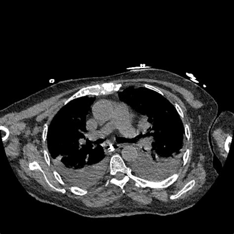 File Mesenteric Vascular Occlusion Bowel Infarction And Portal Venous