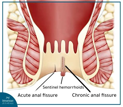 Internal Anal Fissure Anal Fissure Abdominal Key