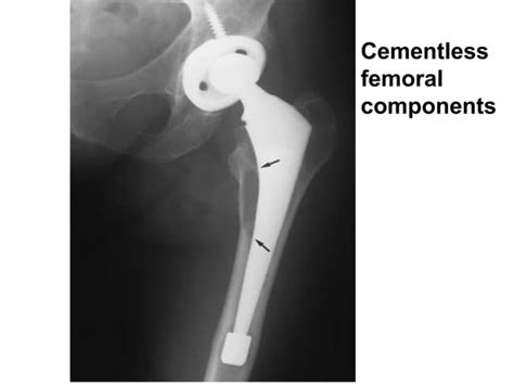 Aseptic Loosening Total Hip Arthroplasty