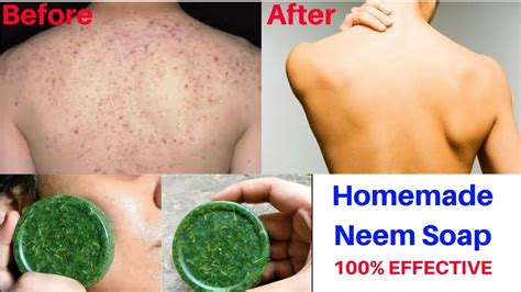 Anti Acne Homemade Neem Soap Get Rid Of Body Acne Neem Soap For Acne Pimples Spotless Skin