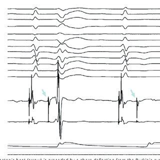 Twelve Lead Electrocardiogram With Intracardiac Electrograms From