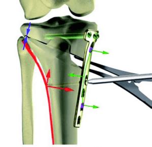 High Tibial Osteotomy - Dr Shannon Sim