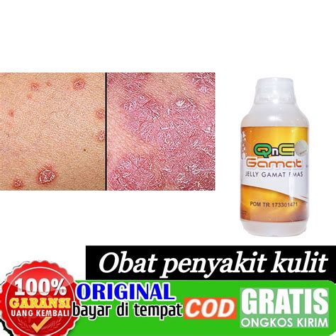 Jual Obat Penyakit Kulit Psoriasis Eksim Basah Kering Gatal Kulit