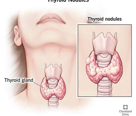 Thyroid Ablation For Solid And Cystic Tumor Interventional Radiology