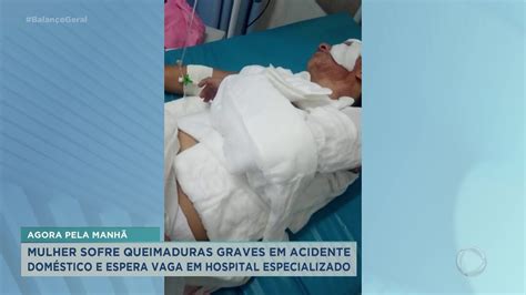 Mulher Sofre Queimaduras Graves Ap S Acidente E Espera Vaga Em Hospital