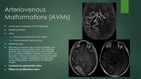 Vascular Malformations Thumb Learn Neuroradiology