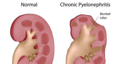 The Symptoms of Kidney Infection (Pyelonephritis) – Page 3 – Entirely ...