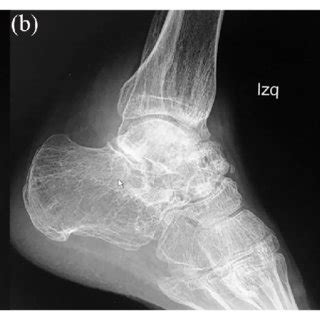 A Osteonecrosis Of The Talus On A T Weighted Sagittal Mri Slice And