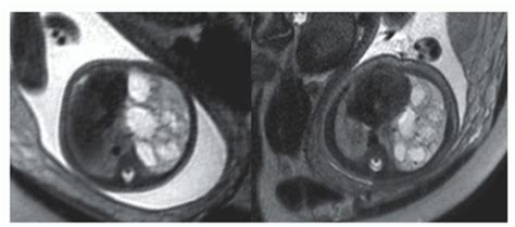 Fetal Preoperative Imaging Obgyn Key