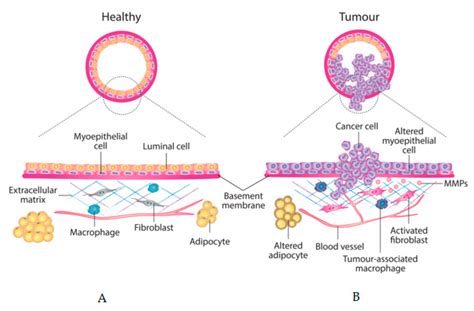 Jcm Free Full Text Breast Mammographic Density Stromal Implications On Breast Cancer