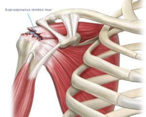 Rotator Cuff Tear Prevention | Rebalance Sports Medicine