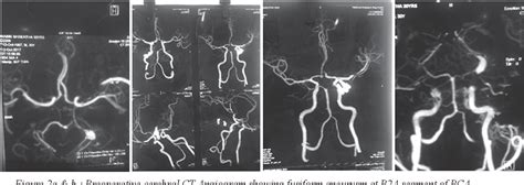 Figure From Giant Thrombosed Aneurysm Of P Anterior Segment Of Left