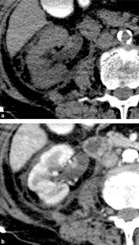 Figure 2 From Multiphase Whole Body CT Angiography Before Multiorgan