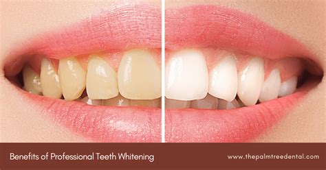 Top 3 Teeth Whitening Benefits Benefits Of Professional Teeth Whitening