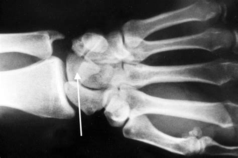 Dislocation Wrist Perilunate Hand Surgery Resource