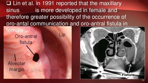 Maxillary Sinus Fistula