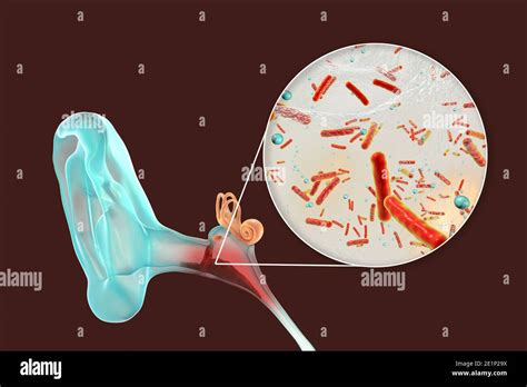 Otitis Media Ear Infection Illustration Stock Photo Alamy