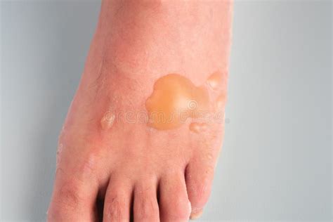 Burn Blisters On A Man`s Foot Caused By Boiling Water Accident It`s An