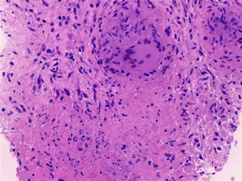 Figure From A Case Report Of Extra Pulmonary Tuberculosis Presenting