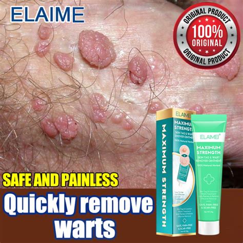 Remover G Elaimei Warts Remover Original Skin Tags Remover