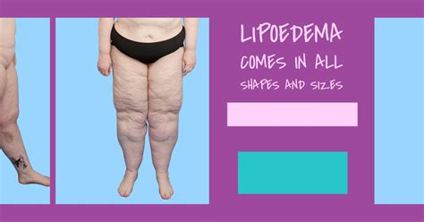 Symptoms and Stages of Lipoedema | Talk Lipoedema