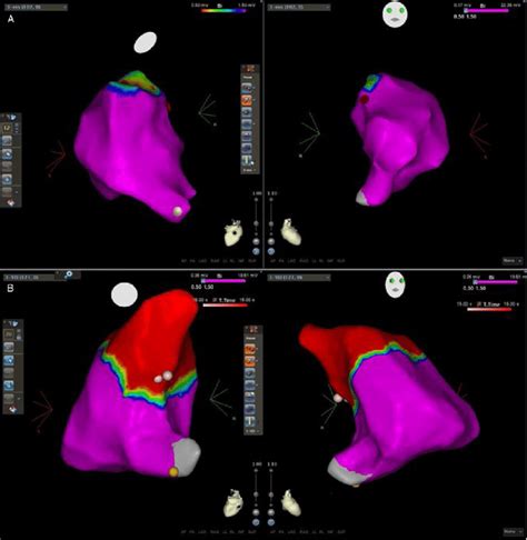 Three Dimensional Electroanatomical Voltage Maps Of The RVOT A A