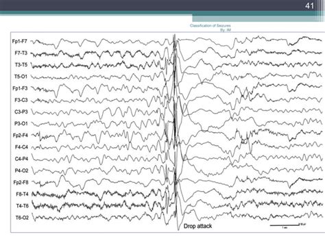 Classification Of Seizures By Ilae Ppt