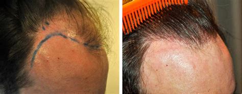 Grafts Hair Transplant Coverage Results Costs