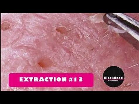 Whitehead And Blackhead Removal Extraction Youtube