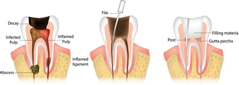 Endodontics Root Canal Montclair Plaza Dental Group