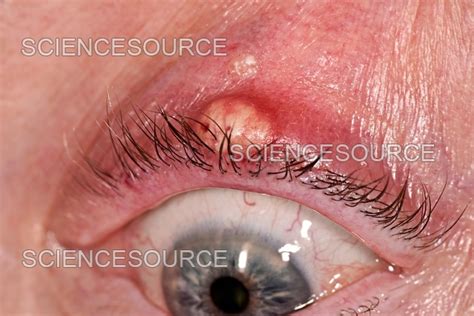 Chalazion Cyst On An Eyelid Stock Image Science Source Images