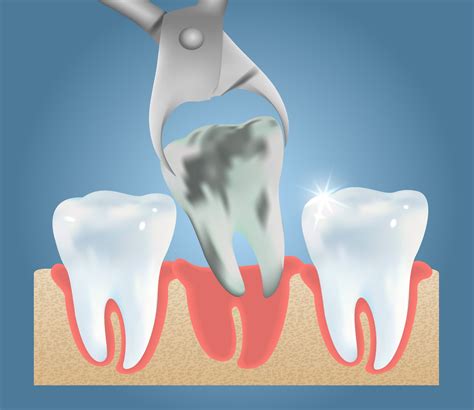 Tooth Extraction | Artistic Touch Dentistry