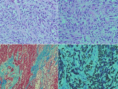 Microfotografías neoplasia epitelial de cé lulas fusiformes con