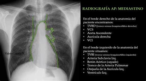 Radiografía de Tórax Bordes del Mediastino TC TAC