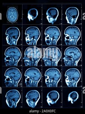 Tdm C R Brale Montrant Un Cavernome Du Tronc C R Bral Une Anomalie