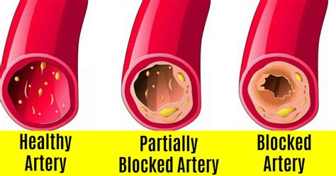 Symptoms Of Blocked Arteries Edta Chelation Uk