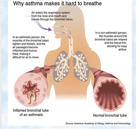 Asthma Flashcards Quizlet