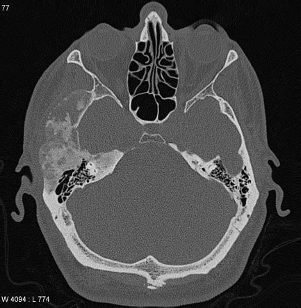 Fibrous Dysplasia Image Radiopaedia Org