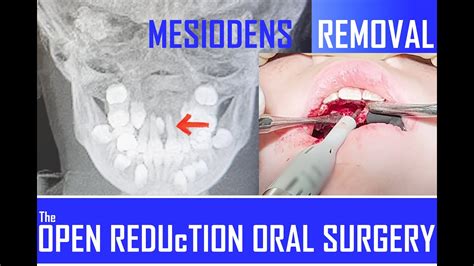 MESIODENS REMOVAL! The COMPLETE WORKUP & SURGERY - YouTube