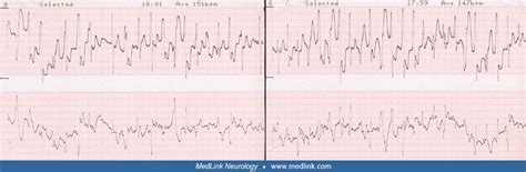 Reflex anoxic seizures | MedLink Neurology