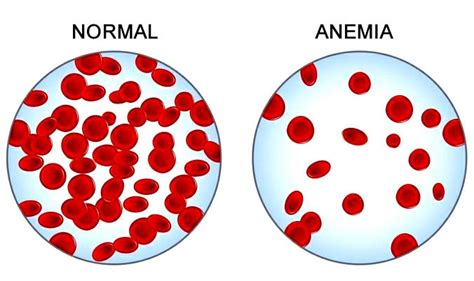 Anemia Causas Sintomas Tratamento E Curiosidades