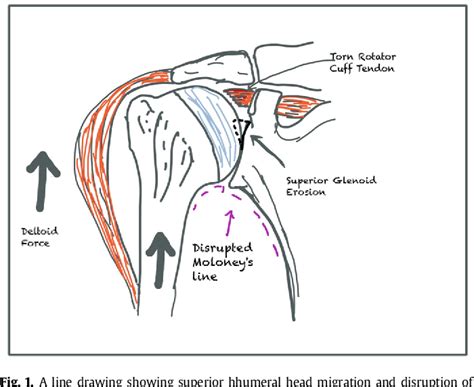 Figure From Subacromial Balloon Spacer Where Are We Now Semantic